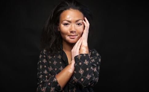 白癜风疾病会有出现哪些并发症